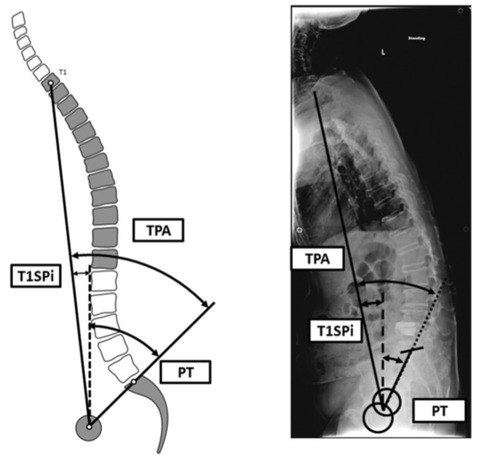 Spinal_deformityに関するreview_Neurosurg__pdf（3___16ページ）