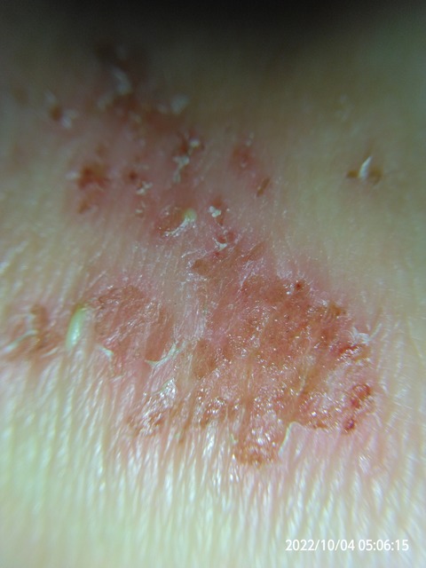痛み・痒み・膿 一体なぜ? : コロナワクチン接種後から体に出た異変