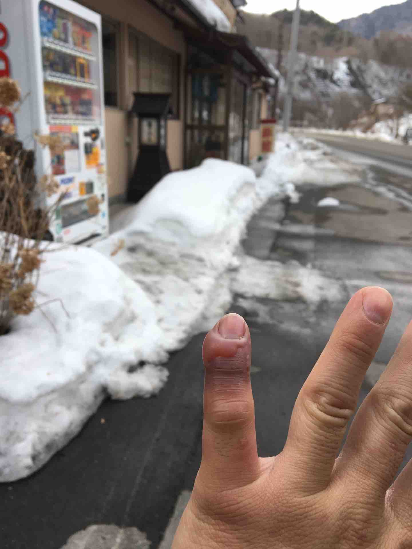 凍傷にかかってしまった おしゃ 的生活 凍傷にかかってしまった おしゃ 的生活