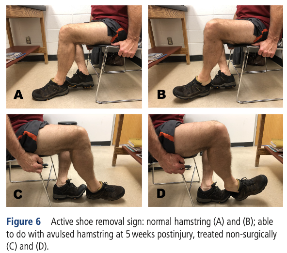 Proximal Hamstring Avulsion : 若手スポーツ整形外科医の自主勉ブログ/成長日記
