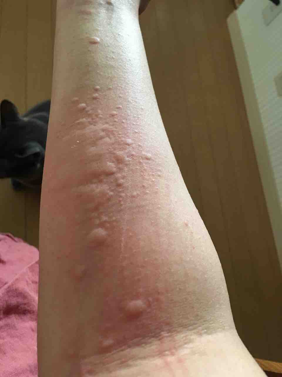 犬 アレルギー 蕁 麻疹