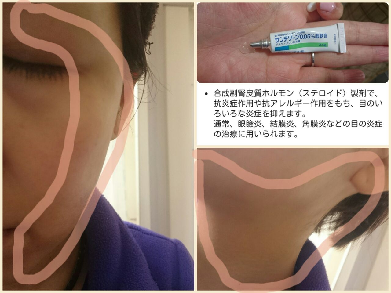 Pm2 5で再び肌トラブル しのぶmama ブログ Pm2 5で再び肌トラブル しのぶmama ブログ