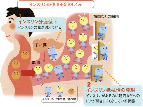糖尿病のリハビリテーション 糖尿病で血液はトロトロに インスリン抵抗性の原因は運動不足 脳卒中にならないためのリハビリテーション 糖尿病のリハビリテーション 糖尿病で血液はトロトロに インスリン抵抗性の原因は運動不足 脳卒中にならないためのリハビリテーション