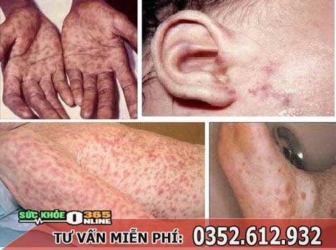 cach-chua-benh-giang-mai-o-nam-nu-gioi