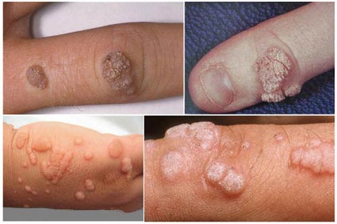 cach-chua-benh-sui-mao-ga-hieu-qua