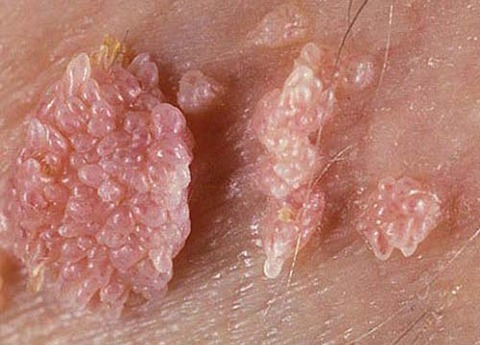 chua-benh-sui-mao-ga-o-dau-tot-nhat