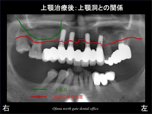 饤1