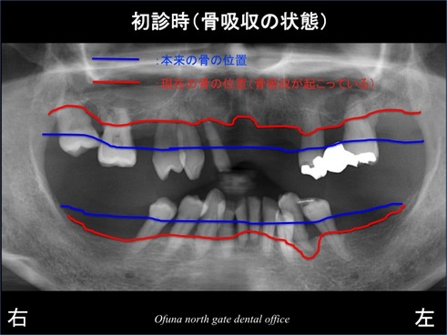 饤1