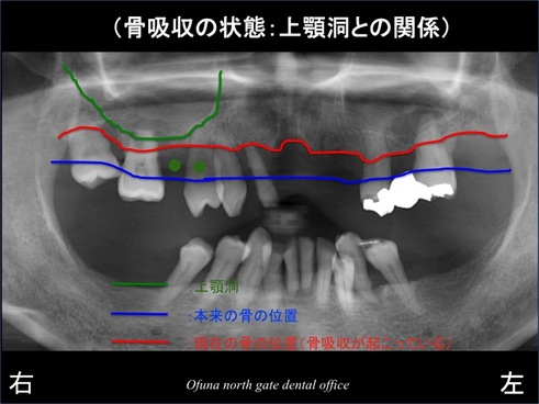 饤1