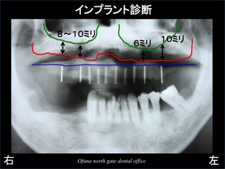 饤1