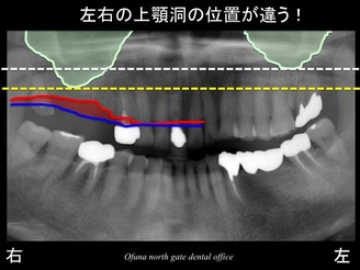 饤11