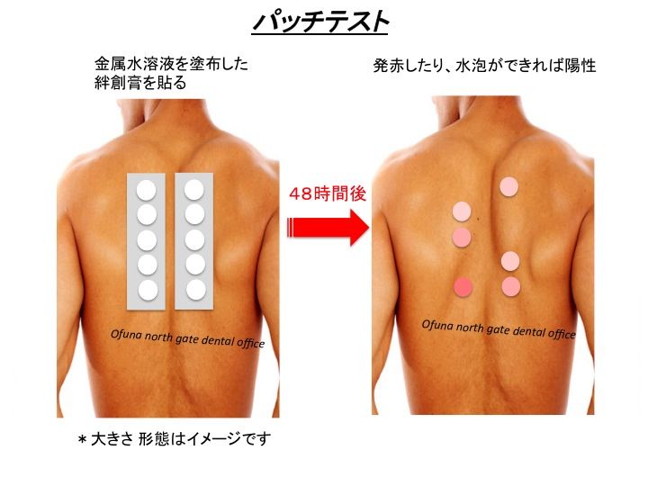 テスト パッチ