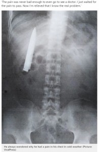 xrayrevealedknifeisinhischest03281309-196x300