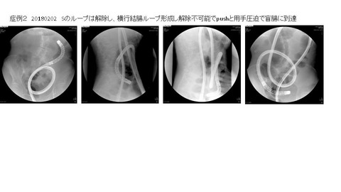 20180202横行結腸ループ形成し解除不可能