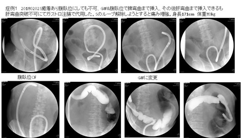 20180202S癒着ありGIFで突破するも肝弯曲突破不可能