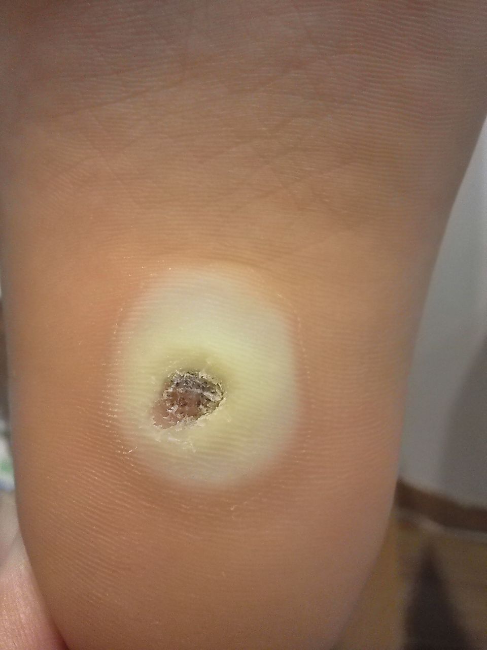 足の裏のイボ 焼いたあと ビワの日記