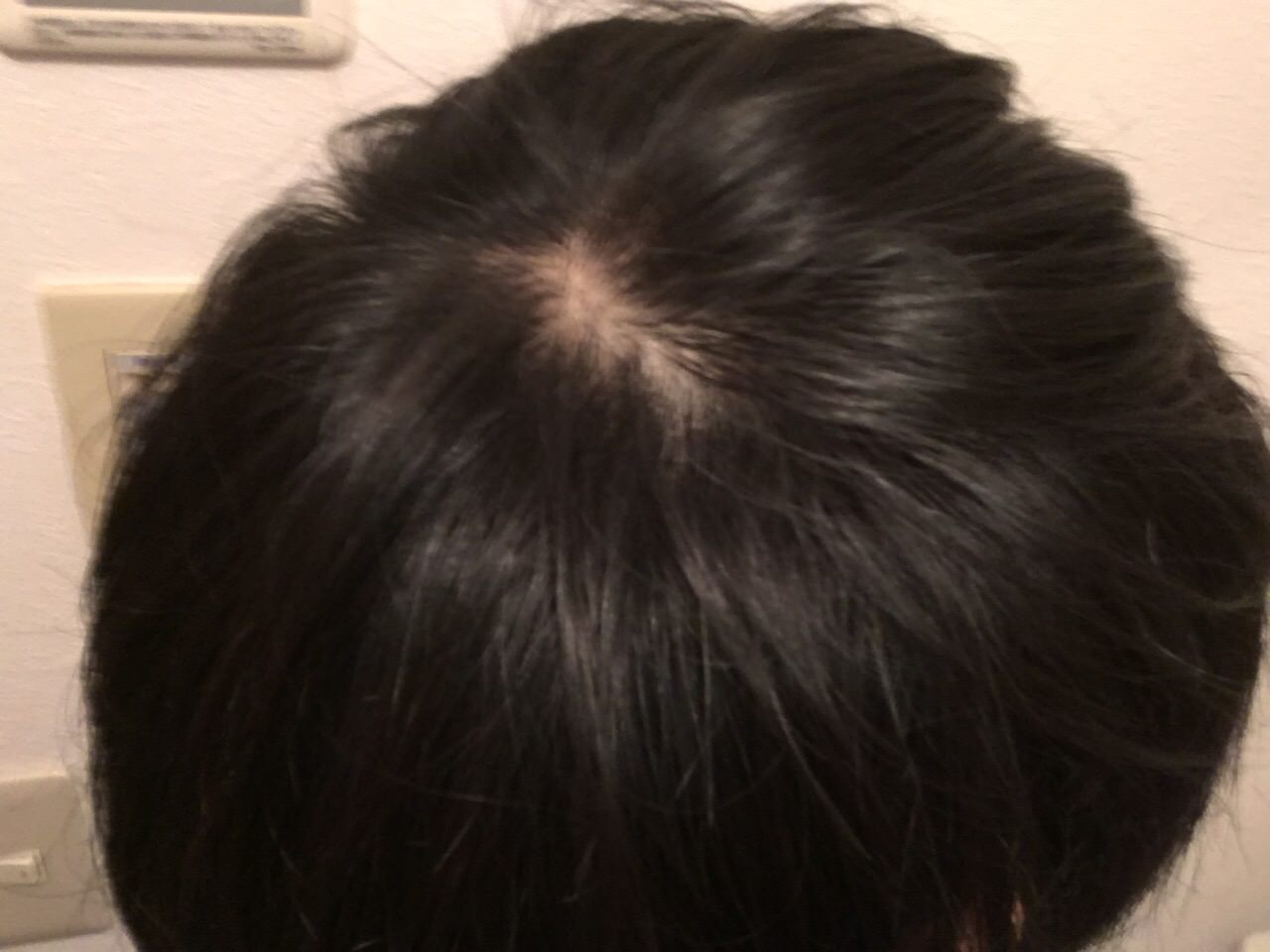 ワイ 24歳にしてここまでハゲ上がる Jのログ おんjまとめブログ ワイ 24歳にしてここまでハゲ上がる Jのログ おんjまとめブログ