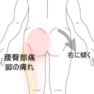 腰痛