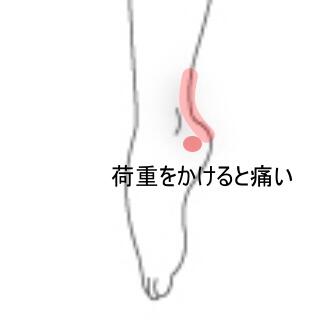 外果の痛み