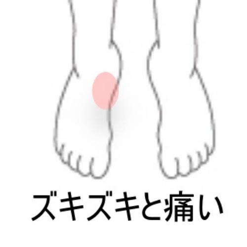 有痛性外脛骨 室蘭登別すのさき鍼灸整骨院症例報告 すのさき鍼灸整骨院 副院長のブログ 有痛性外脛骨 室蘭登別すのさき鍼灸整骨院症例報告 すのさき鍼灸整骨院 副院長のブログ