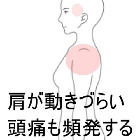 石灰沈着性腱板炎