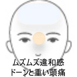 頭痛