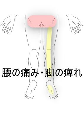 腰椎すべり症