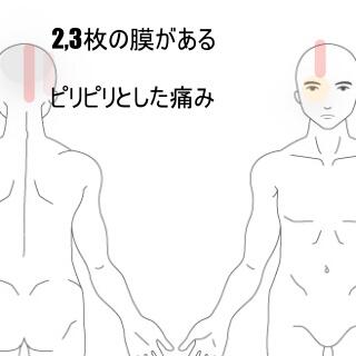 帯状疱疹後神経痛