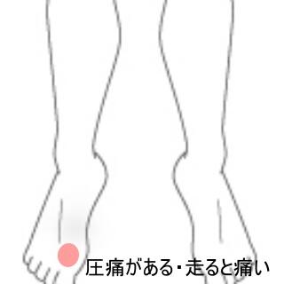 趾の痛み