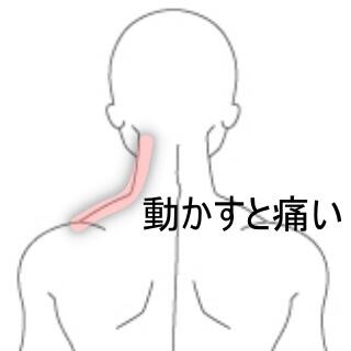 頸部痛