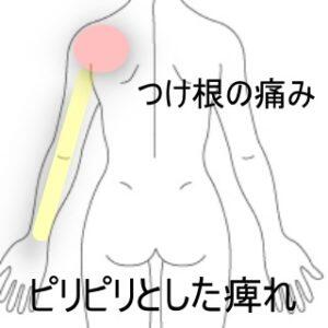 腕の痺れ