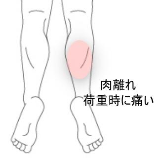 ふくらはぎの痛み