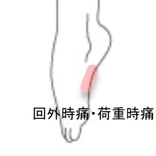 ジョーンズ骨折
