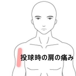 肩の痛み