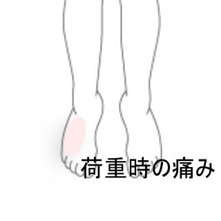 足首の痛み