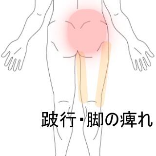 脚の痺れ