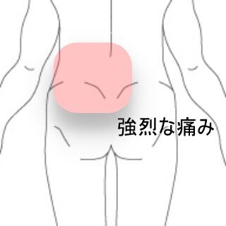 ギックリ腰