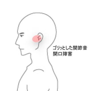顎関節症