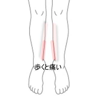 シンスプリント