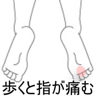 モートン病