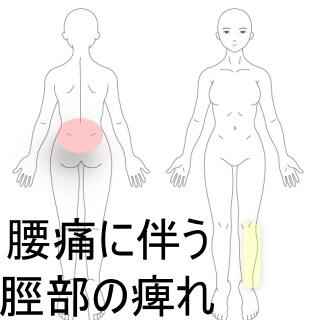 腰痛と脛の痺れ