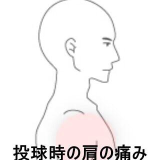 肩の痛み