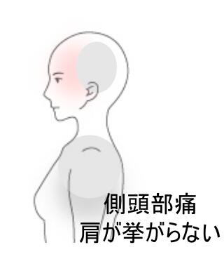 側頭部痛
