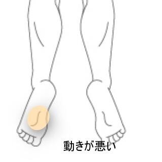 足首の痛み