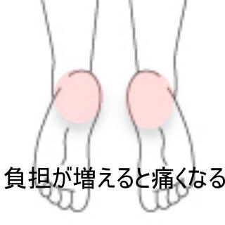 踵の痛み