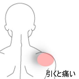 肩の痛み