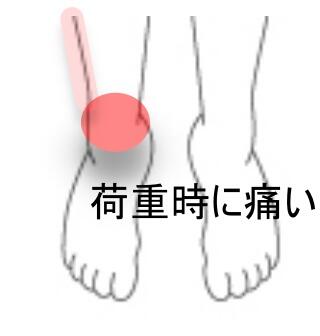 足首捻挫痛