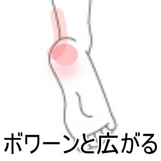 1踵の痛み