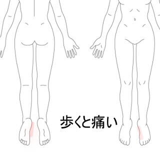 足底筋膜炎