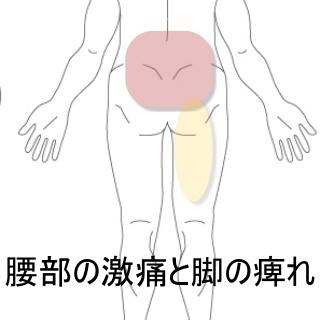 腰部の激痛と脚の痺れ